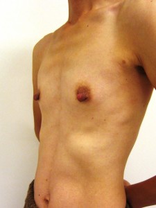 術前　左前斜位